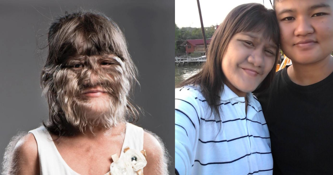 The World’s Hairiest Girl Is Now Grown Up, Happily Married and Rocks Her New Style After Shaving